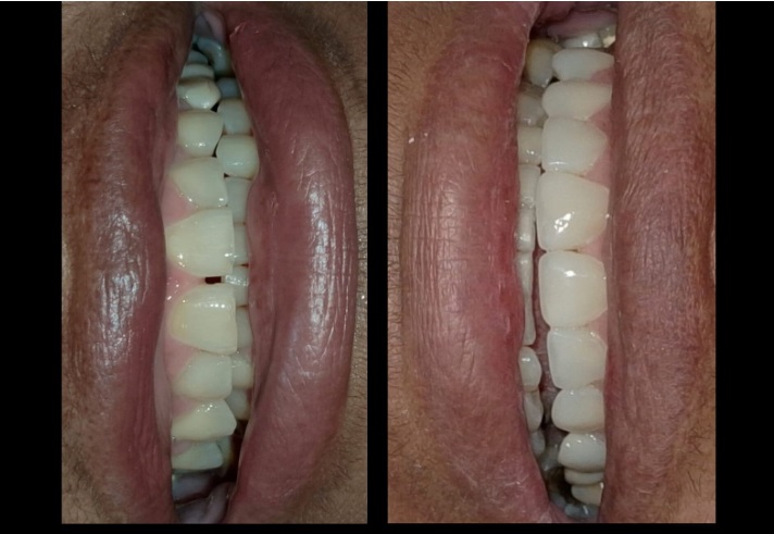 Transformação com facetas em resina