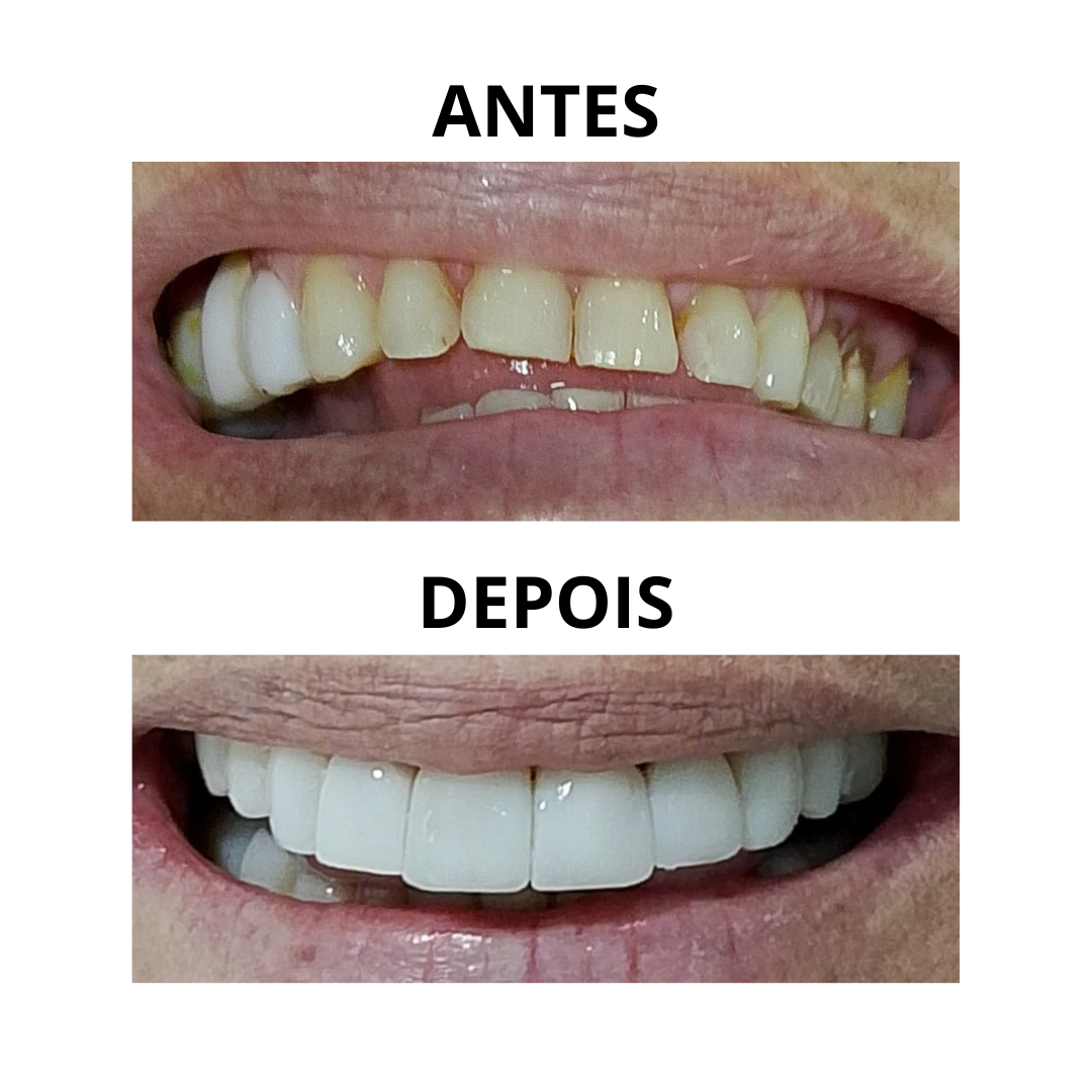 Antes e depois de facetas em resina